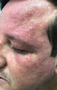 Image result for Skin Eruptions Face