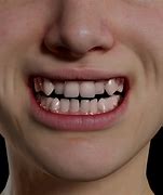 Image result for Invisible Line for Teeth