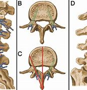 Image result for Lower Thorasic Spine Screw Placement