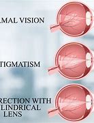 Image result for Contact Lens for Myopia and Astigmatism