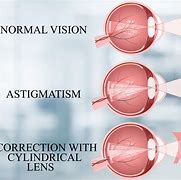 Image result for Astigmatism Cure