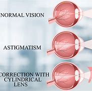 Image result for Blurry Vision with Contacts Astigmatism