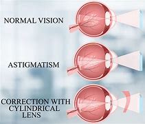 Image result for Astigmatism Axis