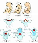 Image result for Spina Bifida and Anencephaly