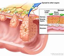 Image result for Average Size of Colon Polyps