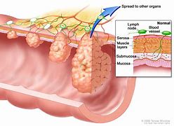 Image result for How Big Is 6 Cm Tumor