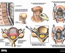 Image result for Anterior Subluxation of C4 On C5