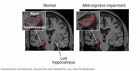 Image result for Brain Shrinking Disease Symptoms