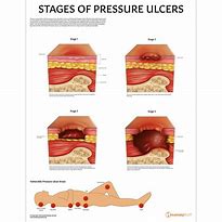 Image result for Comparing Pressure Injury to Apple's