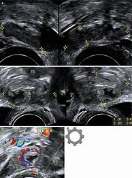 Image result for Adnexal Mass Ultrasound