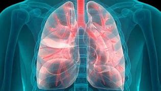 Image result for 2 Cm Nodule On Lung