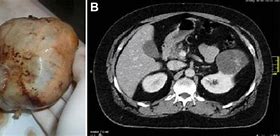 Image result for 9 Cm Complex Cyst On Kidney
