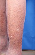 Image result for Lotus Seed Pod Skin Disease