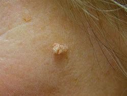 Image result for What Causes Filiform Warts