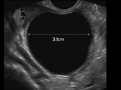 Image result for 8 Cm Ovarian Cyst