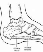 Image result for Plantar Wart Surgery
