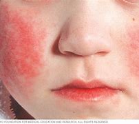 Image result for Parvo Rash