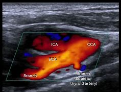 Image result for FMD Carotid Ultrasound