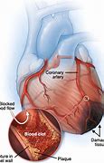 Image result for Myocardial Infarction and Heart Failure
