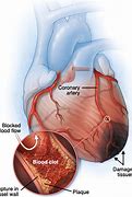 Image result for myocardial infarction