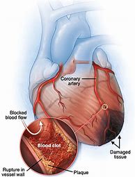 Image result for Anterior Wall Myocardial Infarction