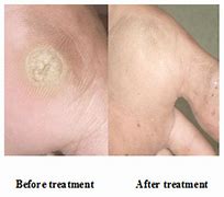 Image result for Skin Warts Treatment