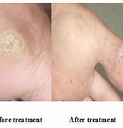 Image result for Skin Wart Removal