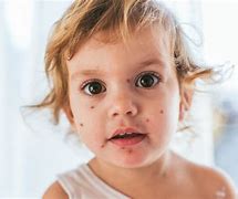 Image result for Chicken Pox On Baby