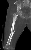 Image result for Spiral Fracture Incision Scar
