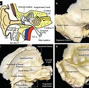 Image result for Coffin Bone Solar Canals