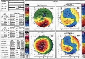 Image result for Corneal Topography After Lasik