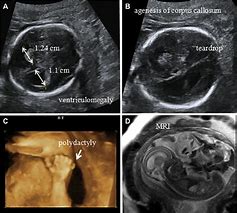 Image result for Corpus Callosum Agenesis Fetal Ultrasound