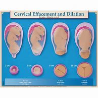 Image result for What Does 1 Cm Dilated Look Like