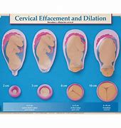 Image result for 10 Cm Dilated Chart