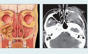 Image result for Squamous Cell Carcinoma Nasal Cavity