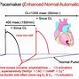 Image result for Re-Entry Arrhythmia