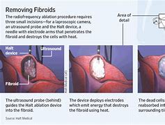 Image result for Uterine Fibroid Ablation