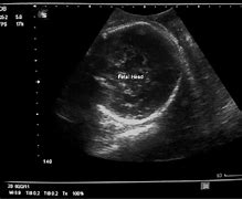 Image result for 4 Cm Dilated Cervix