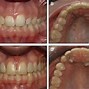 Image result for Temporary Lateral Incisor