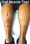 Image result for Torn Calf Muscle