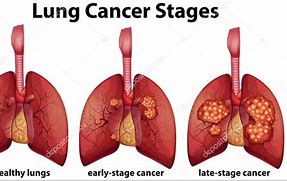Image result for Lung Tumor Size Chart