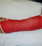 Image result for Picture of an Arm Cast without a Hand
