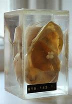 Image result for Teratoma Tumor with Teeth and Hair