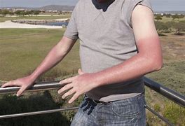 Image result for Sun Poisoning Rash On Chest