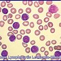 Image result for Chronic Lymphocytic Leukemia Disease