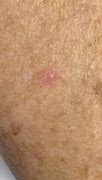 Image result for Solar Keratosis