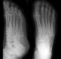Image result for Pseudo-Jones Fracture