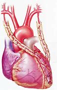 Image result for Coronary Artery Bypass