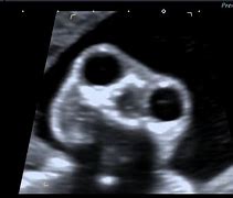 Image result for Anencephaly 8 Week Ultrasound