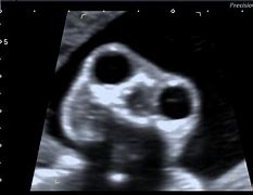 Image result for Anencephaly Treatments